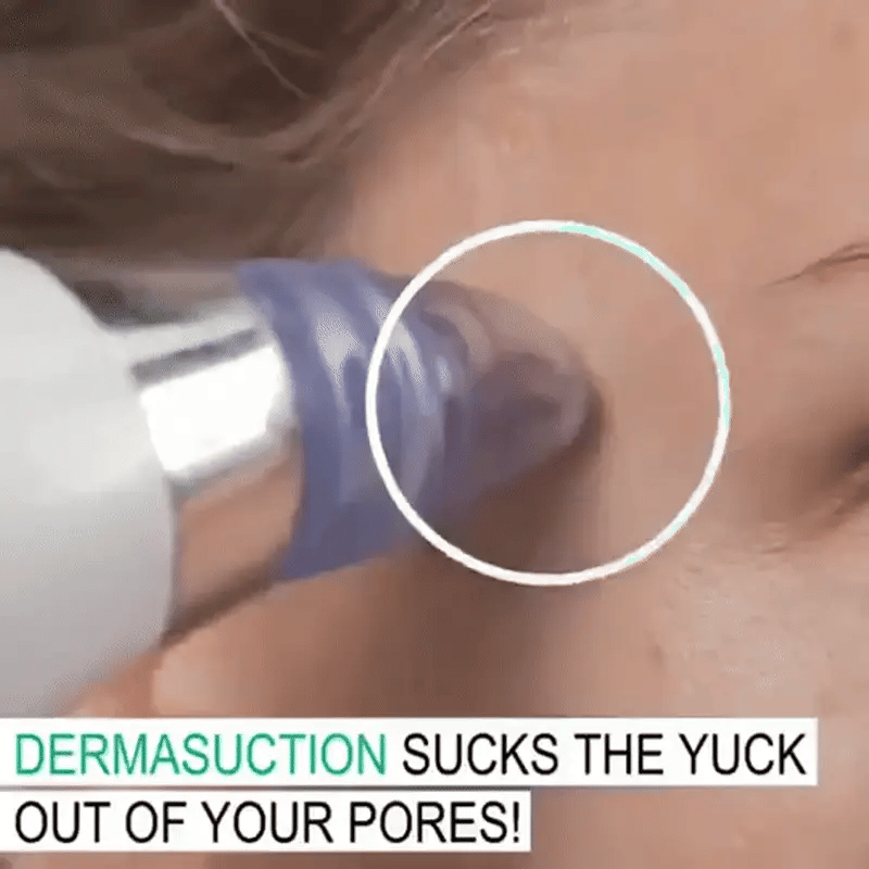 Blackhead Remover – Deep Pore Cleansing Tool