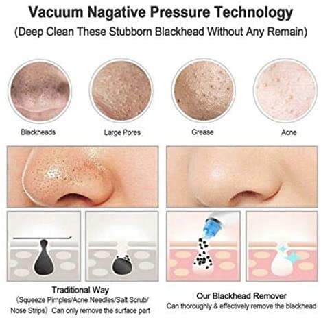 Blackhead Remover – Deep Pore Cleansing Tool